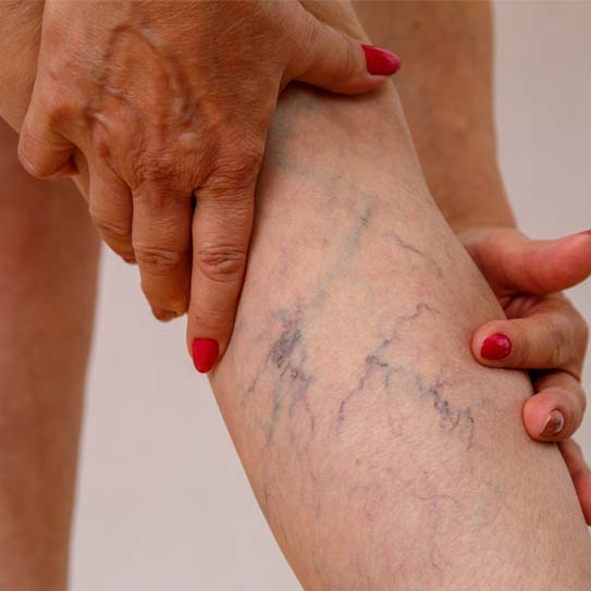 know-more-about-Varicose Veins-treatment-in-Meerut